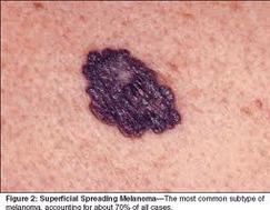 melanoma carcinoma skin cancer malignant characteristics physiology